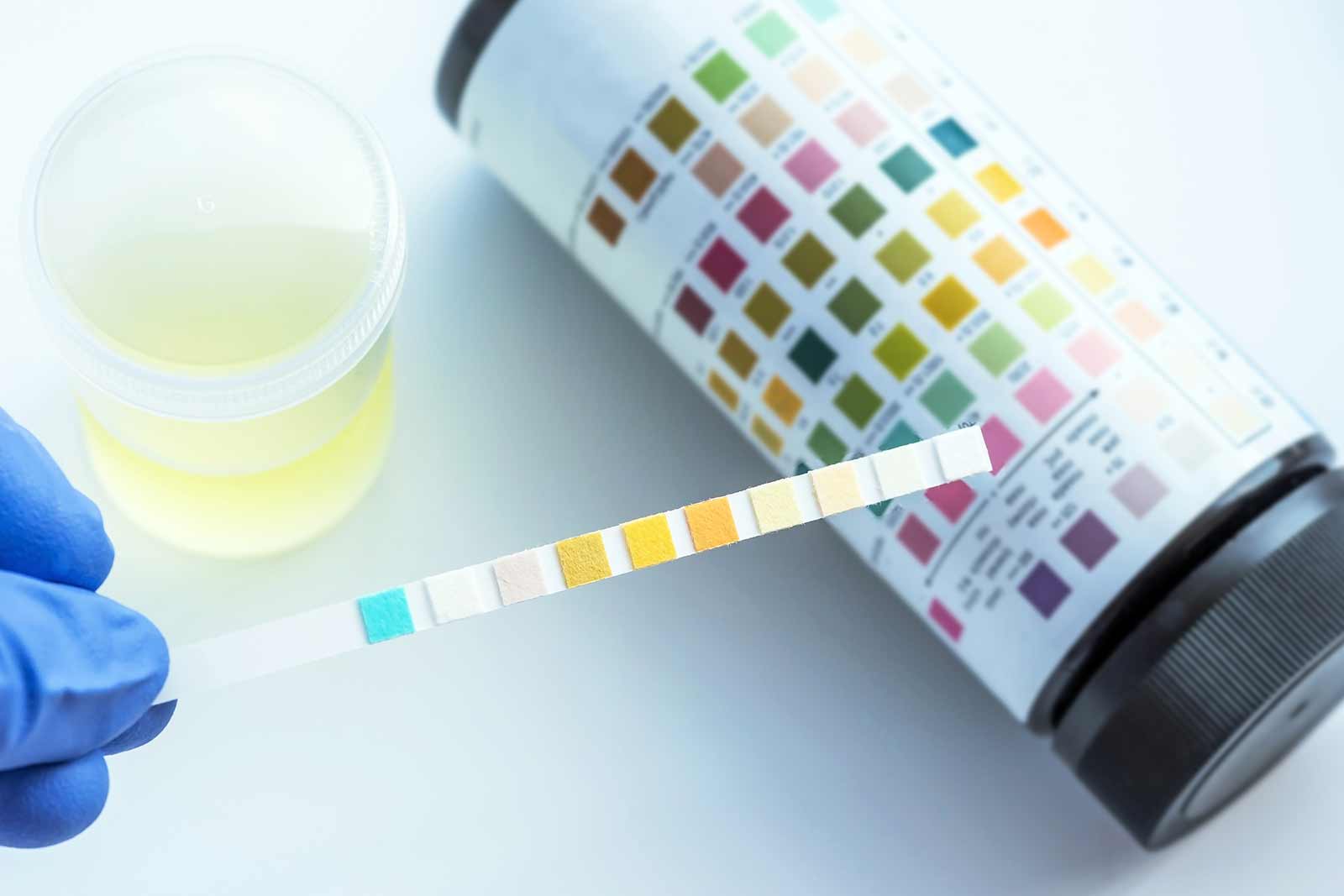 Urinalysis, Urinary Test, UA Urine Test Results